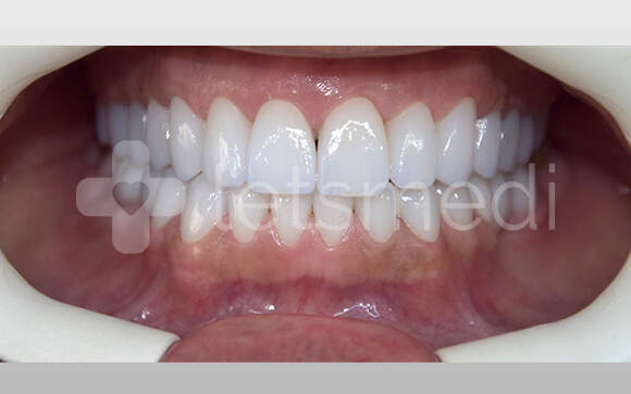 before-after-images (5)