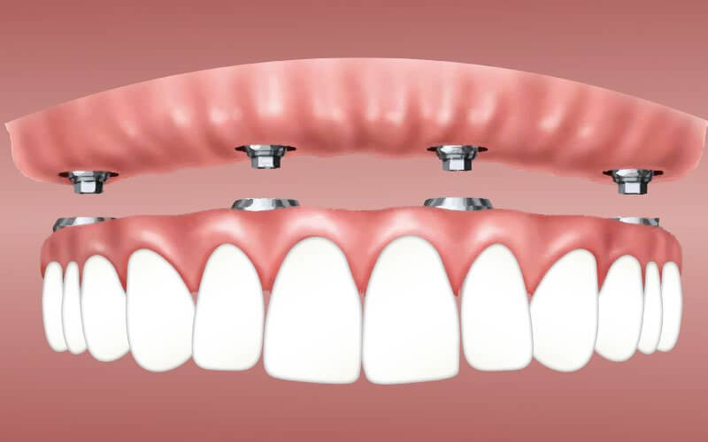 dental-implants-cost-turkey-1