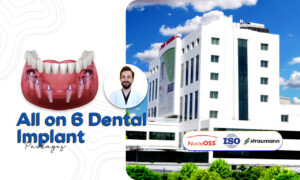 All On 6 Dental Implant