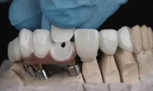 Zirconia Crowns vs Porcelain Crowns