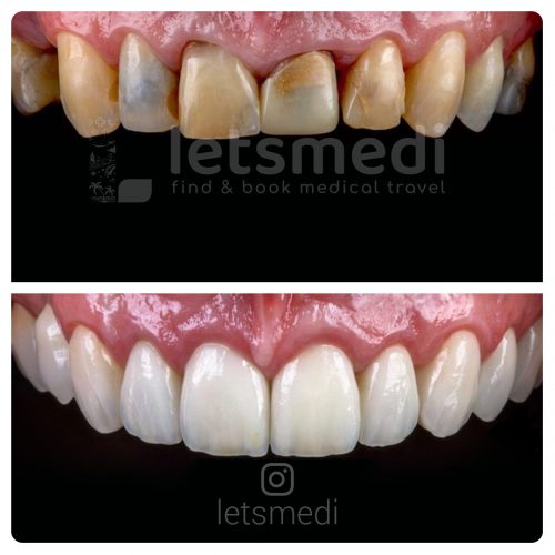 dental crown before and after photos