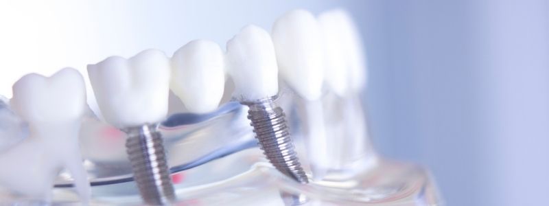 Are You Putting Your Dental Implants at Risk by Smoking