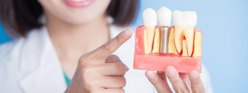 What Should You Not Eat After Getting Dental Implants