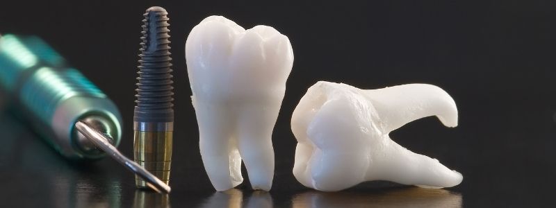 What is the failure rate for dental implants