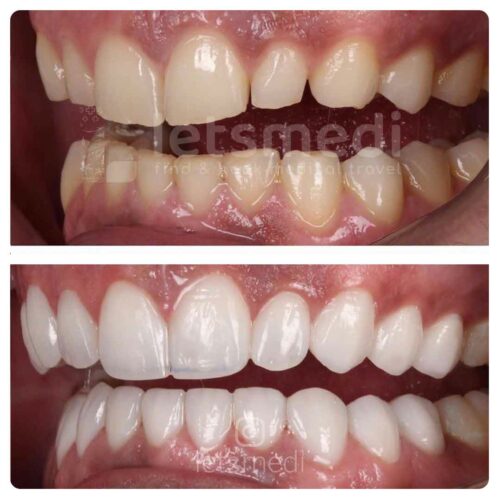 composite-veneers-before-and-after-turkey