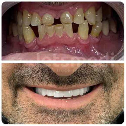 dental-implants-turkey-before-after-3-2
