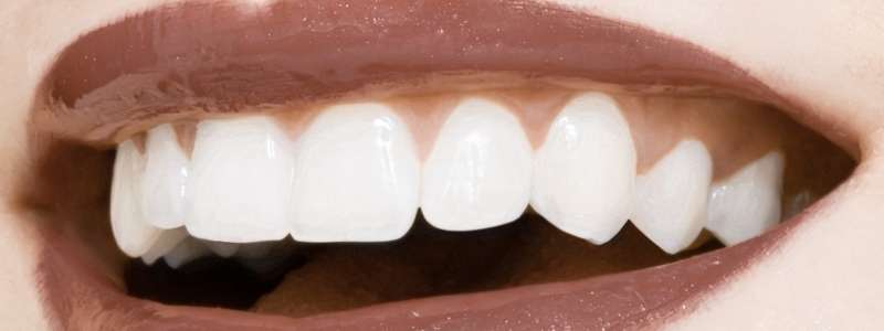 Recovery after Emax veneers