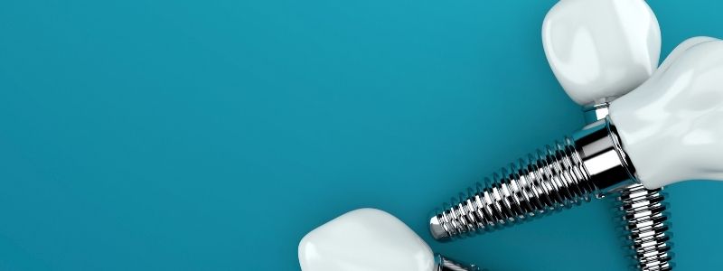 All on 4 Dental Implants Cost in UK