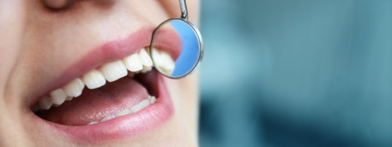 Die verschiedenen Arten von Zahnkronen