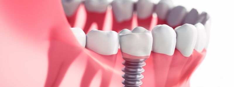 How Much Do Dental Implants Cost in UK ?