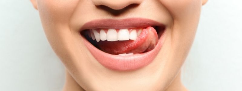 Zahnveneers Vorher und Nachher