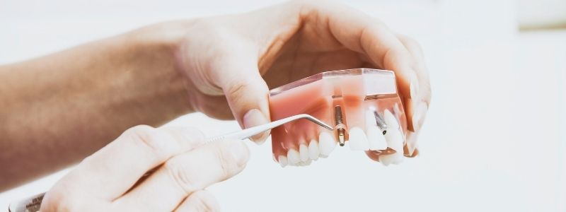 All on 8 Dental Implants Cost