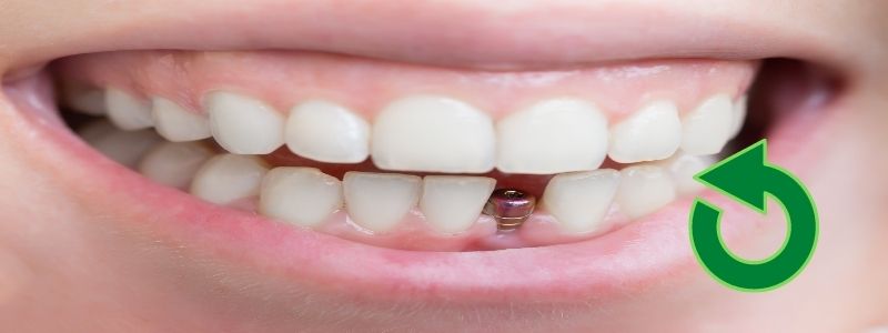 Kann man ein Zahnimplantat erneuern?