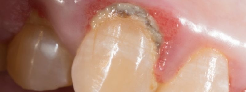 Was tun bei Entzündung unter zahnkrone?