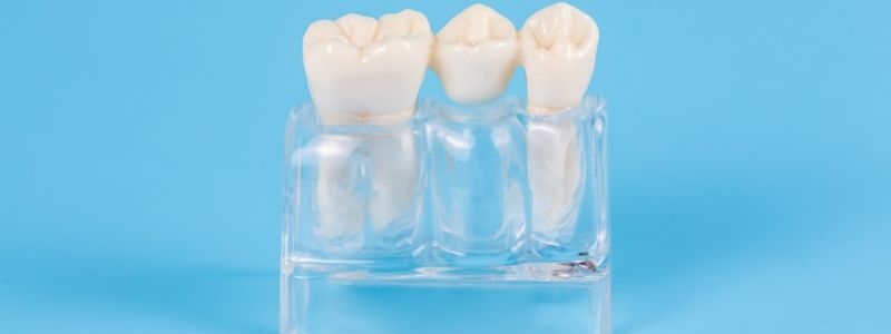 Welche Zahnkrone hält am längsten?