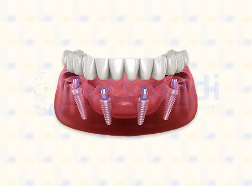 All On 4 Dental Implant in Turkey • Cost & Reviews