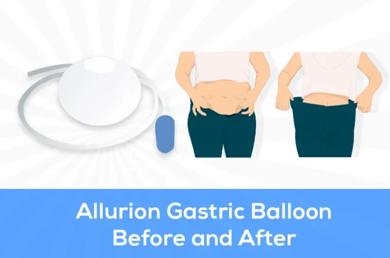 allurion gastric balloon before and after
