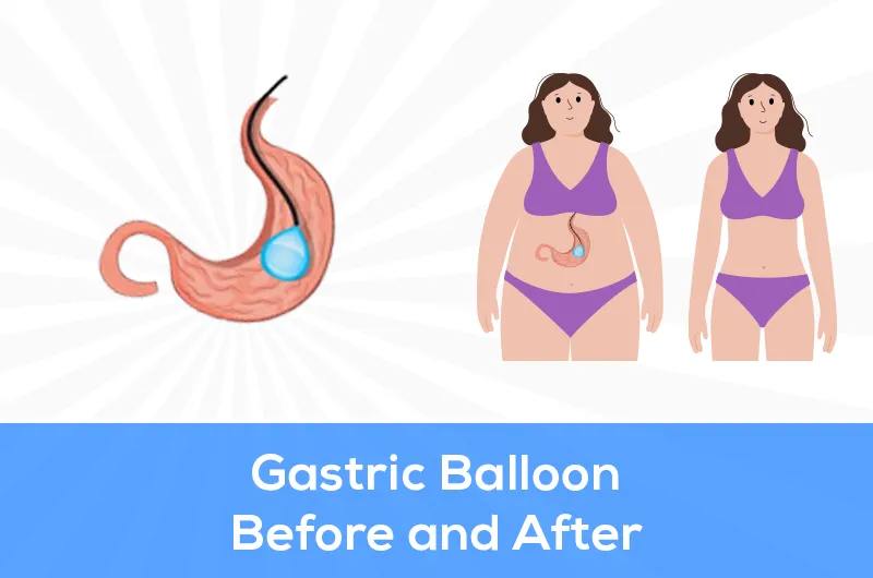 gastric balloon before and after