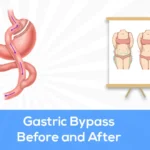 gastric bypass before and after