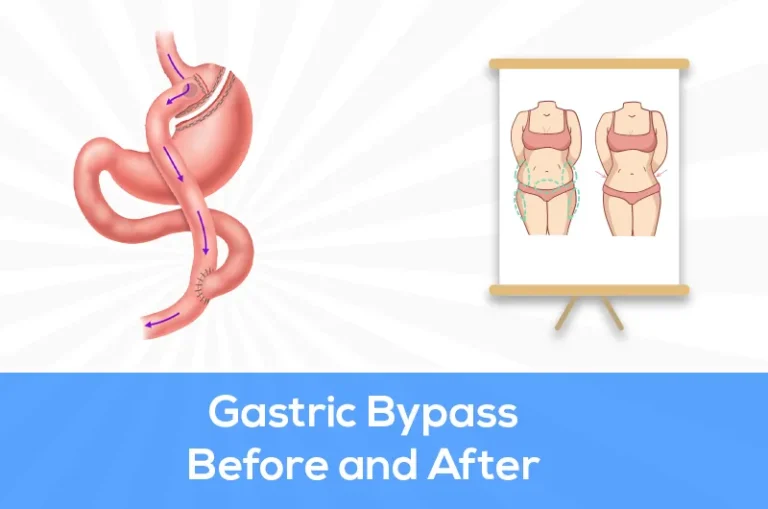 gastric bypass before and after