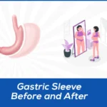 gastric sleeve before and after