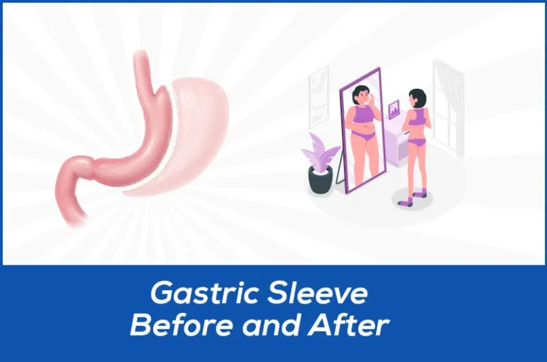 gastric sleeve before and after