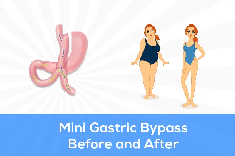 mini gastric bypass before and after