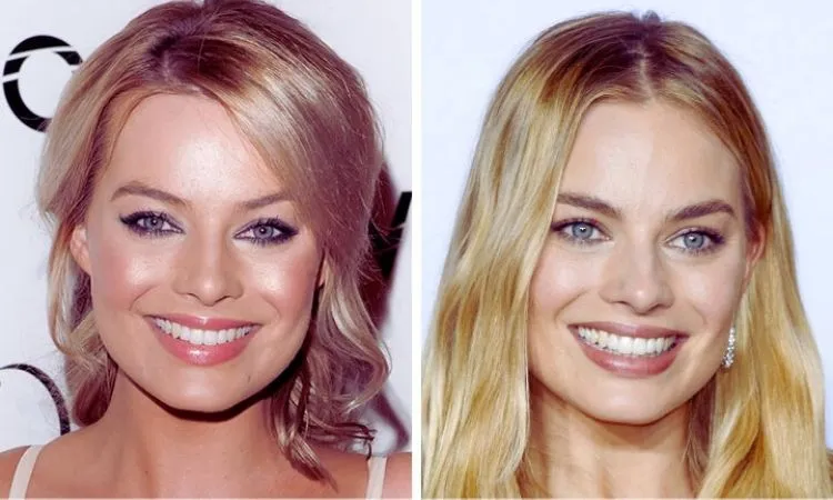 Margot Robbie Veneers