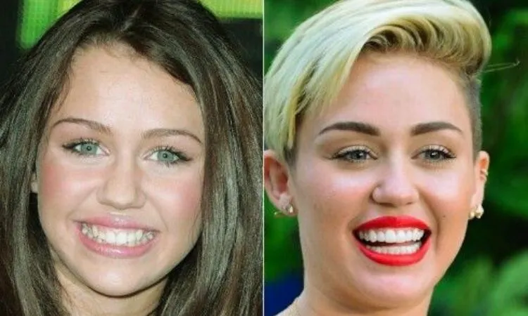 Miley Cyrus Veneers before and after