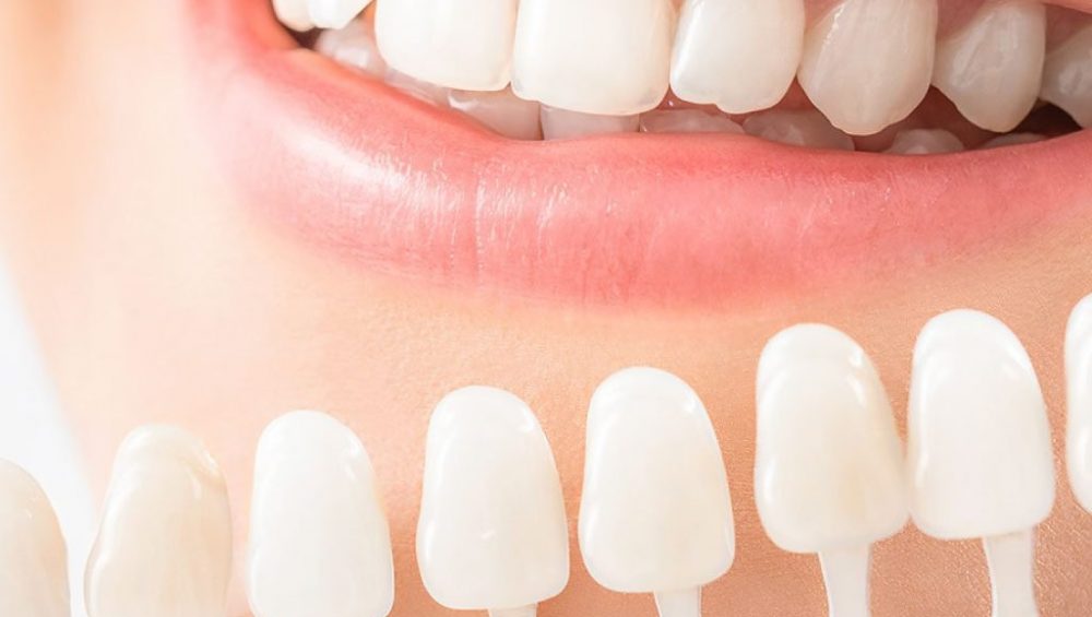 Veneers Turkey
