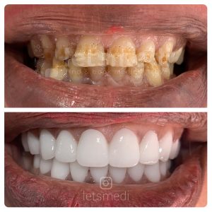 dental crown before and after