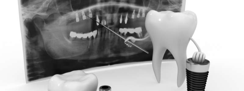 Is it Painful to Get All-on-4 Implants?