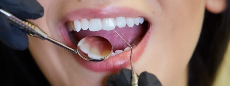 Wann sind Veneers nicht möglich?