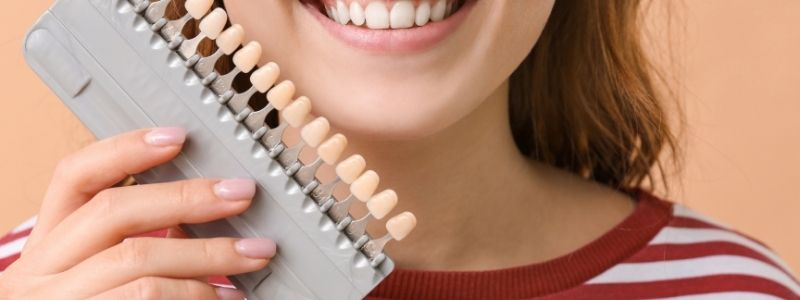 Was sind Veneers?