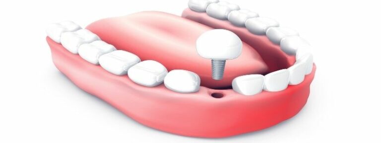 Was tun wenn Implantat nicht hält?