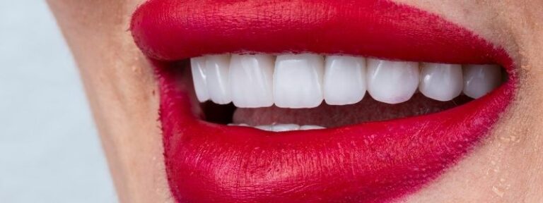 Wie lange halten Veneers?