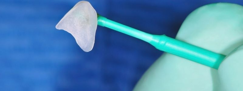 Wie viel wird abgeschliffen von Veneers?
