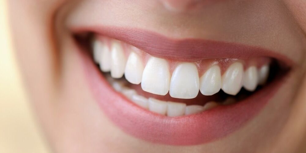 Hollywood Smile OP Vorher Nachher