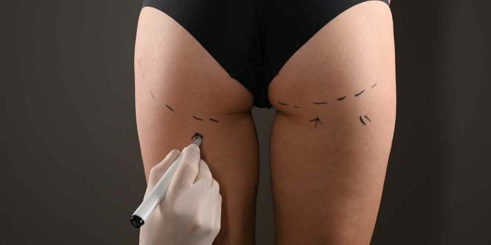 Brazilian Butt Lift Abroad