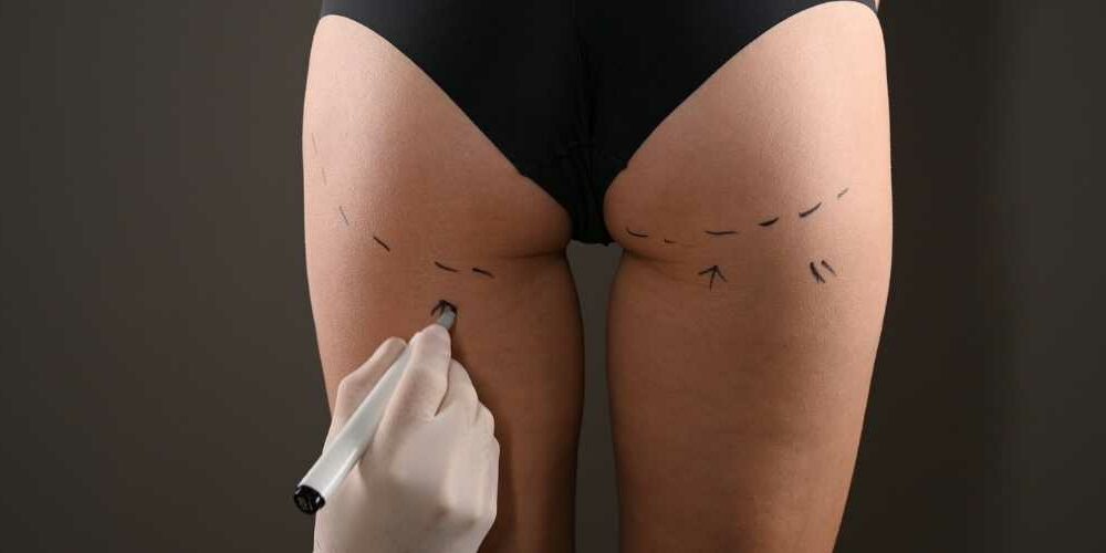 Brazilian Butt Lift Erfahrungen