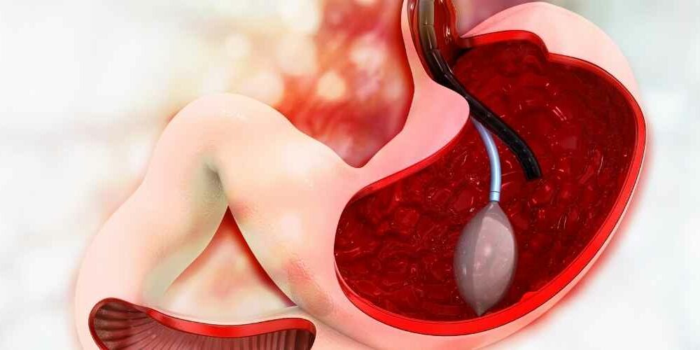 Gastric Balloon Abroad