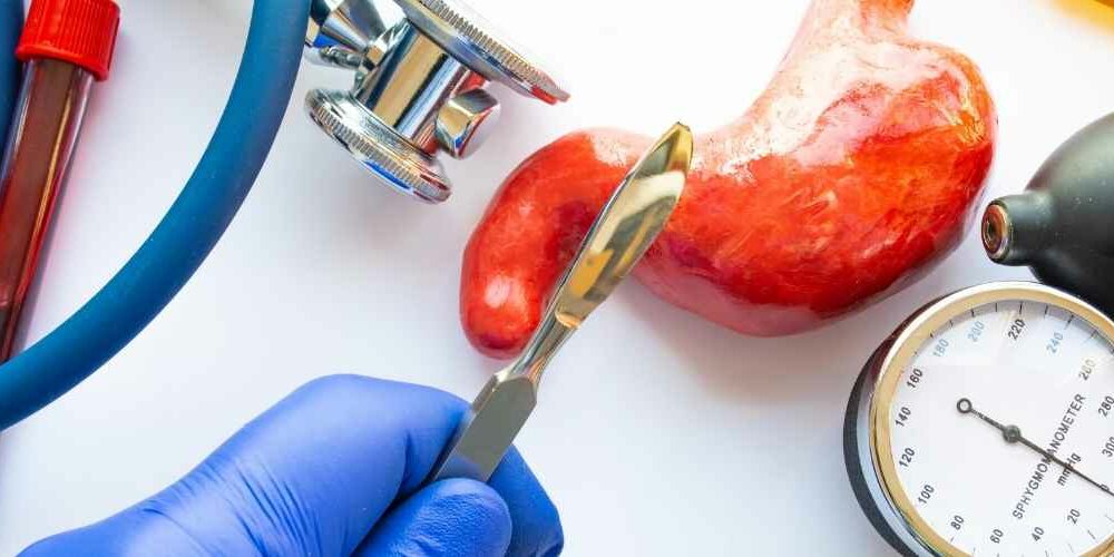 Gastric Sleeve Abroad Letsmedi