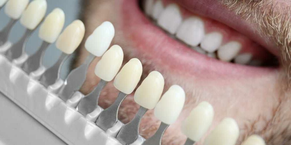 Laminat Veneers Erfahrungen