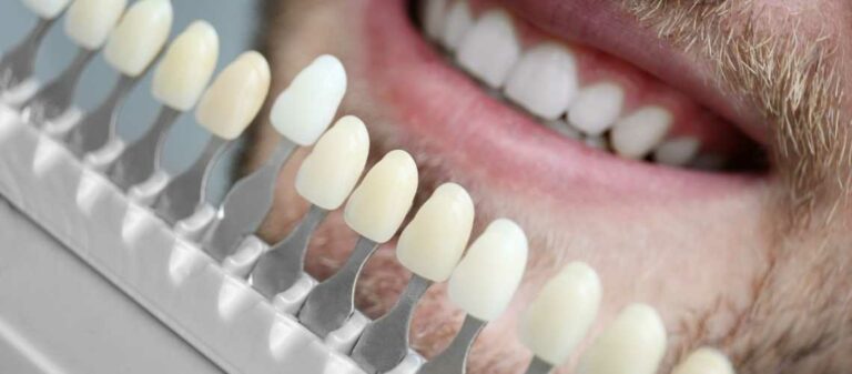 Laminat Veneers Erfahrungen