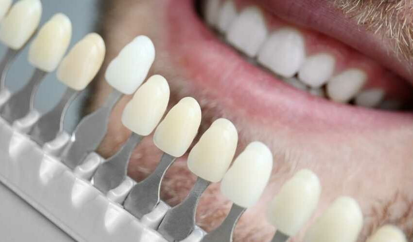 Laminat Veneers Erfahrungen