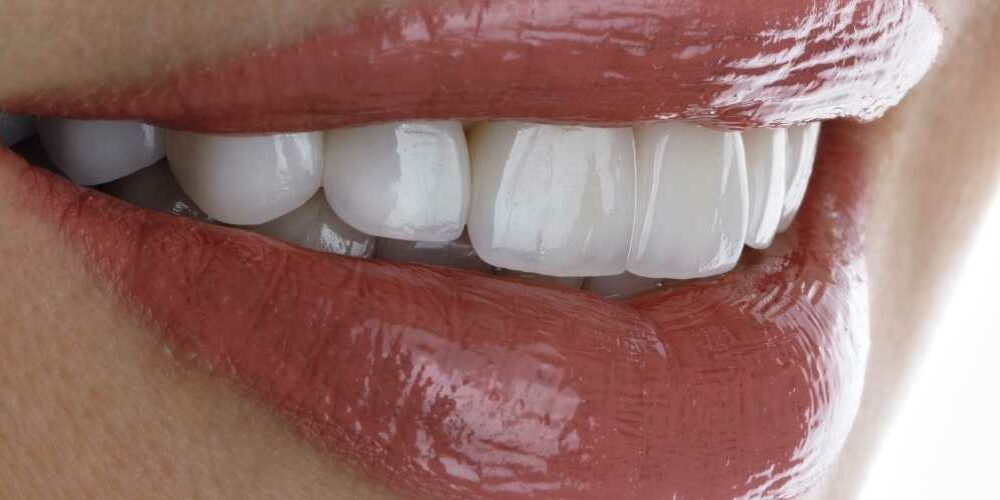 Porzellan Veneers Erfahrungen