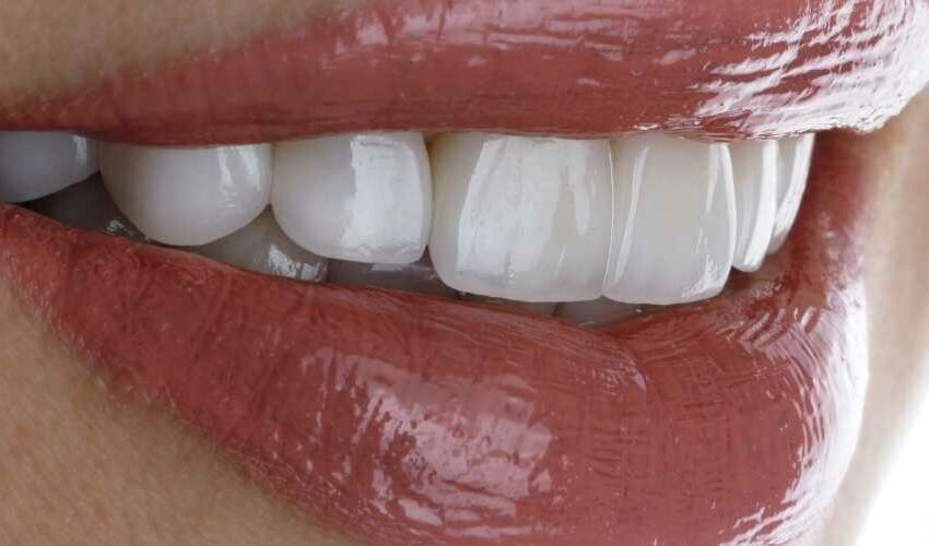 Porzellan Veneers Erfahrungen