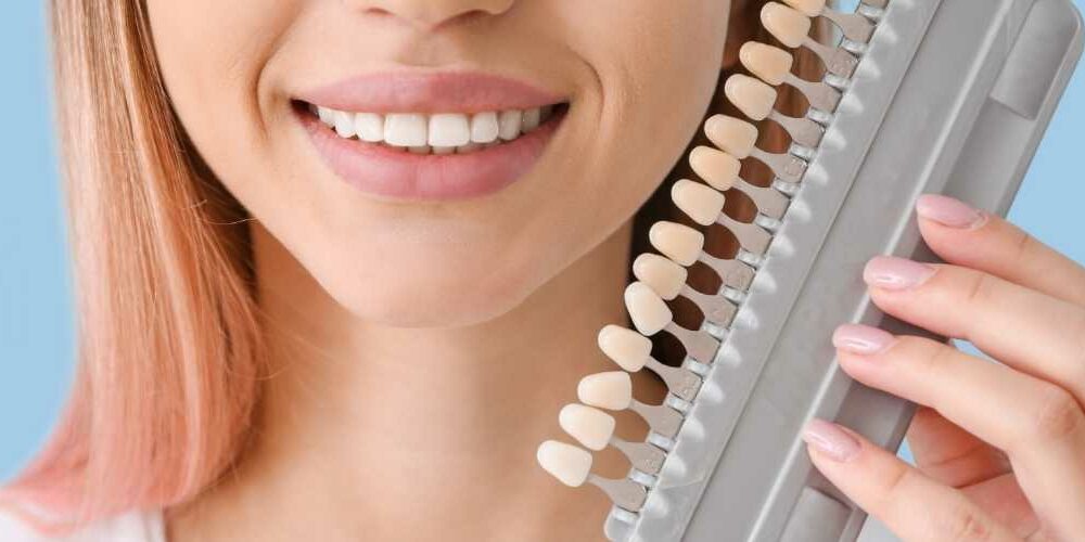 Veneers Erfahrungen