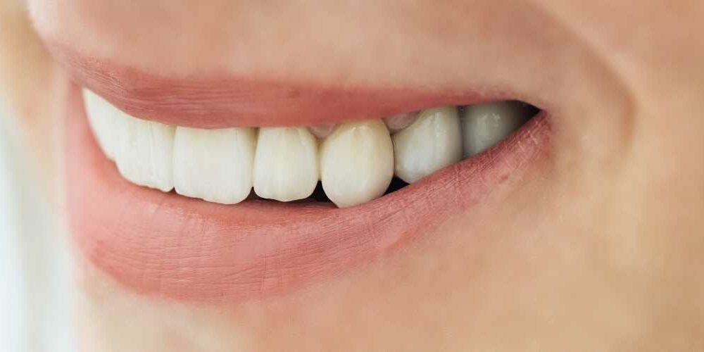 Zirkonium Veneers Erfahrungen