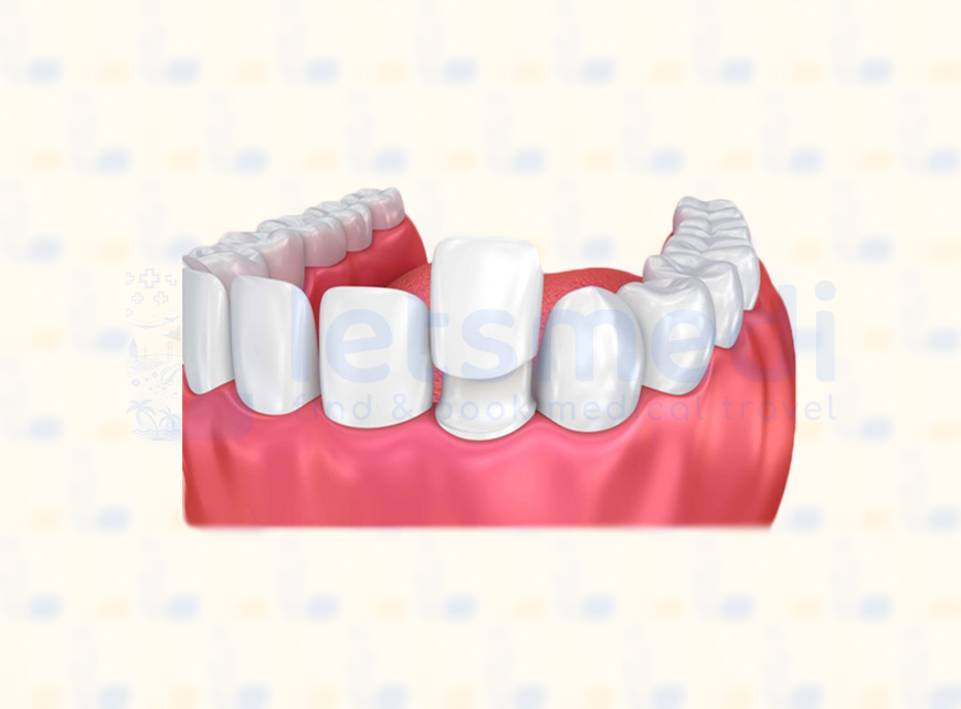 eMax Veneers in Turkey • Cost & Reviews in 2024 Letsmedi